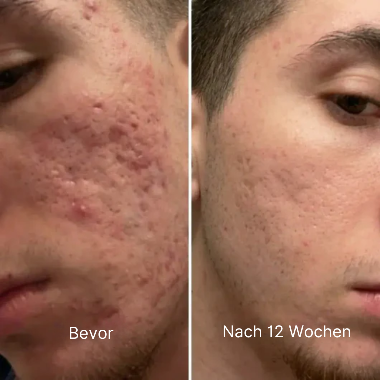 Klinischer Akne-Narben Reparatur Stick™